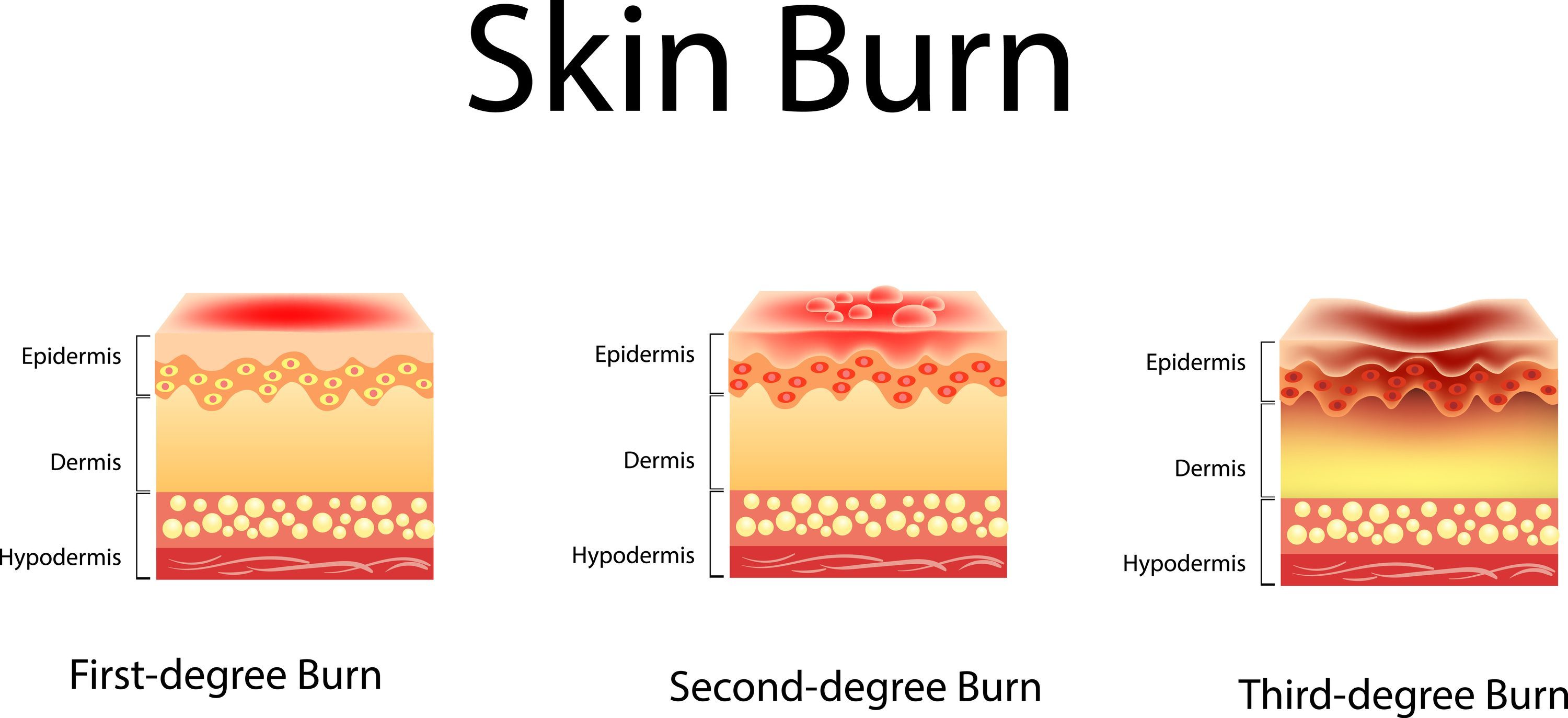 first and second degree burns