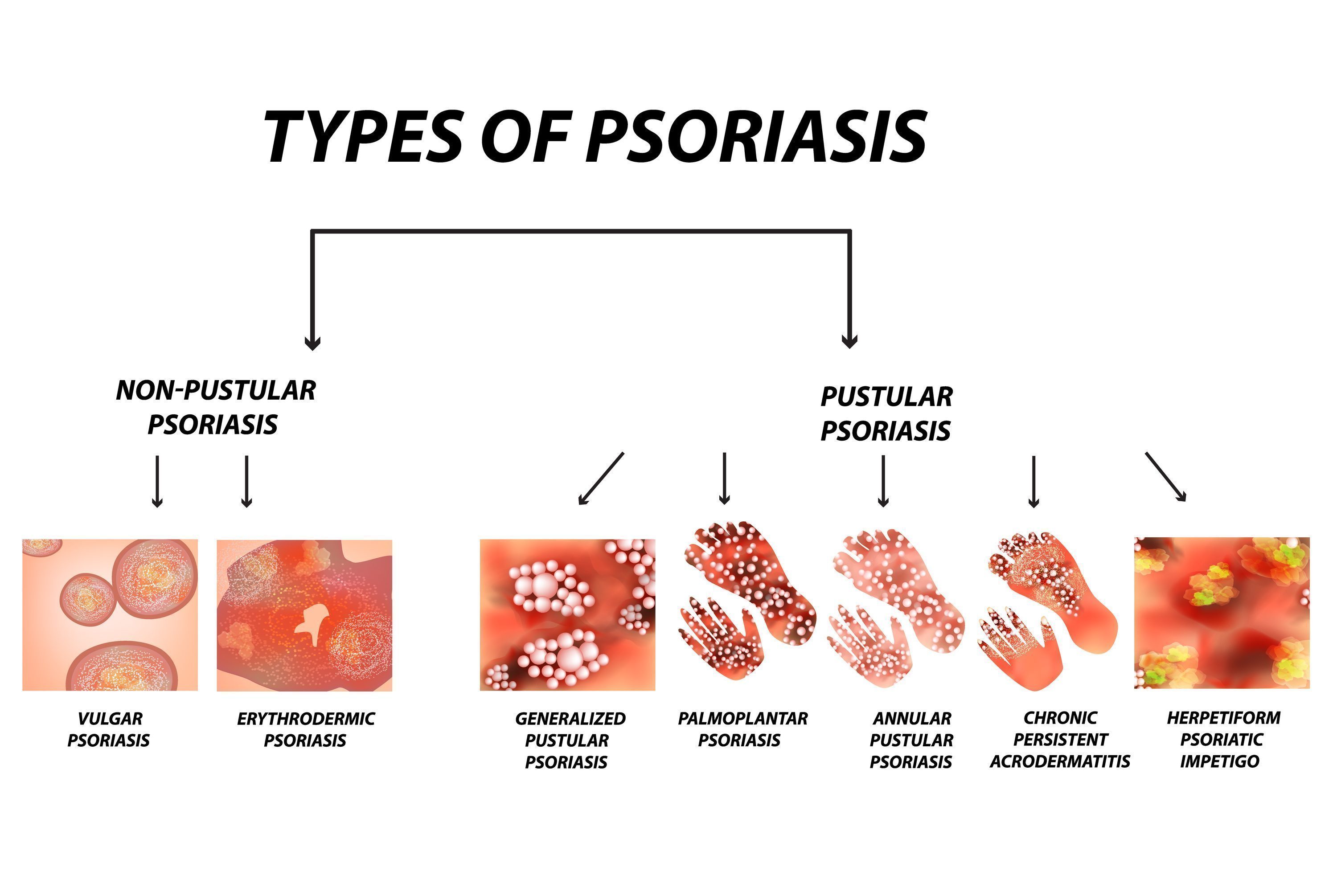 Psoriasis Vs Tinea Versicolor What S The Difference ZOHAL