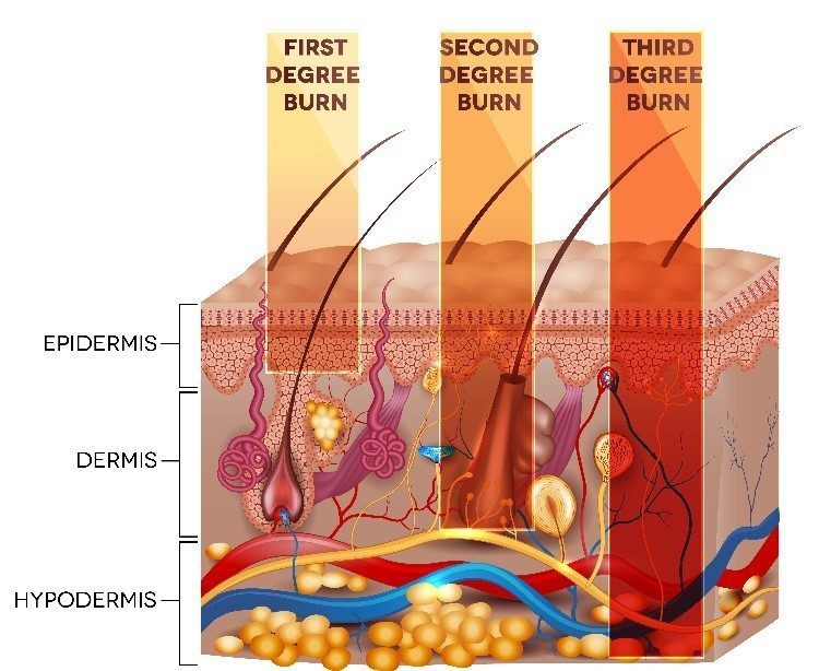 types of burns