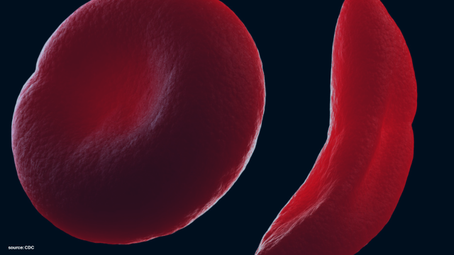 Sickle Cell BASICS from the CDC